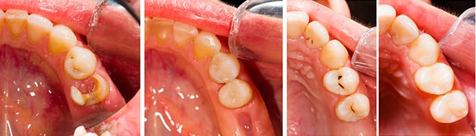 Teeth with decay and after restored with fillings