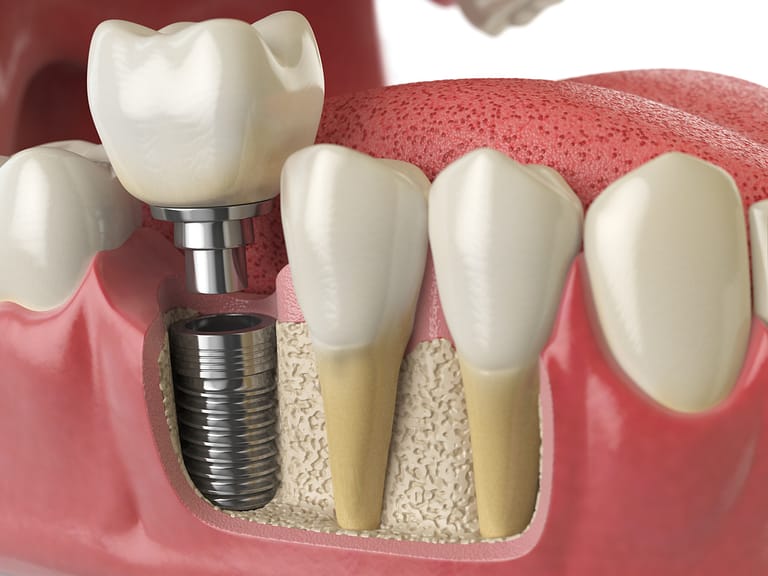 Dental Implants Oshkosh