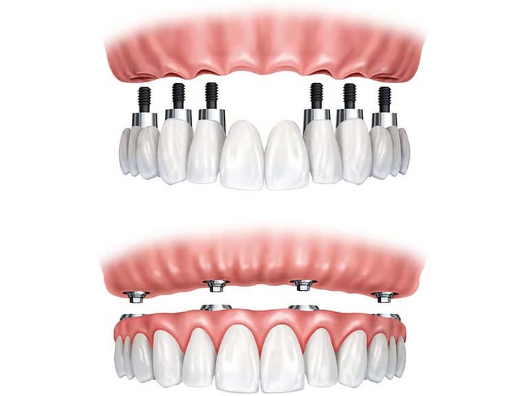 Illustration showing implant reconstruction options.