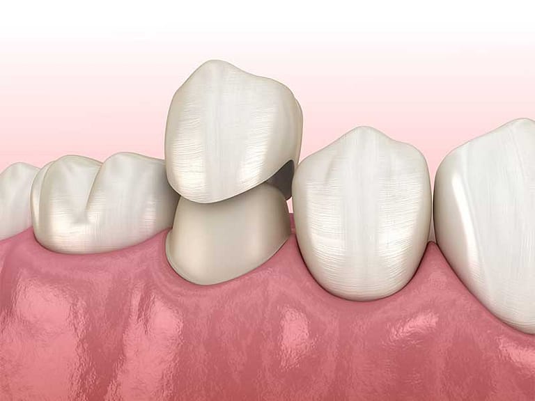 Depiction of a dental crown.