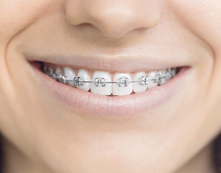 Orthodontic treatment