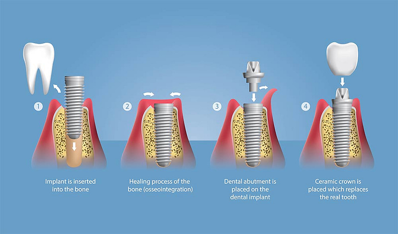 Illustration showing Dental Implants.