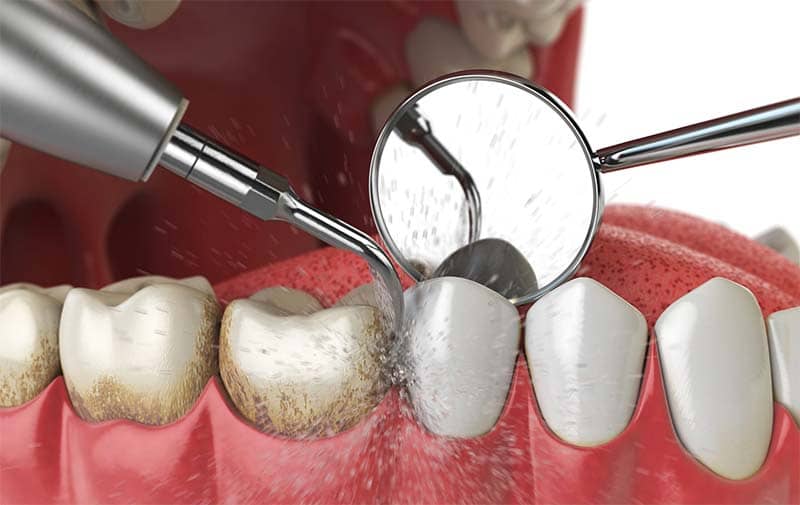 Teeth cleaning illustration.