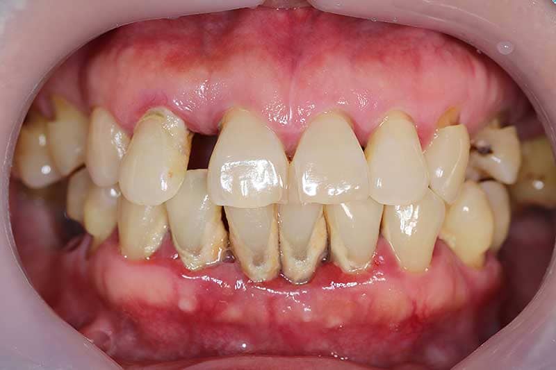 Image of teeth with Gum Disease.
