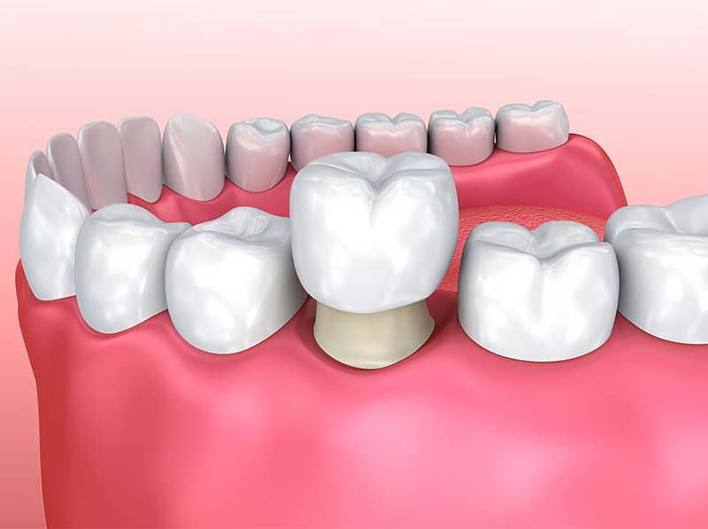 3D illustration of a dental crown.