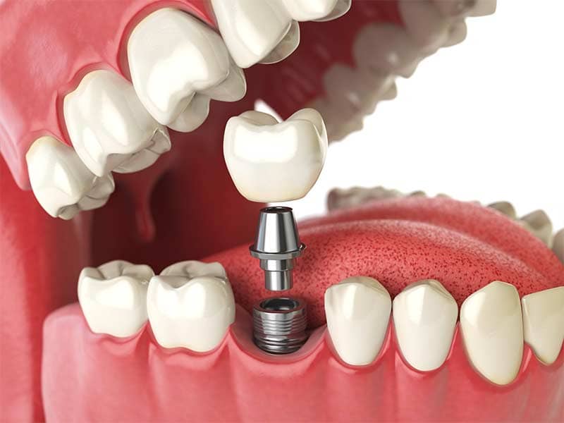 3D illustration depicting a dental implant.