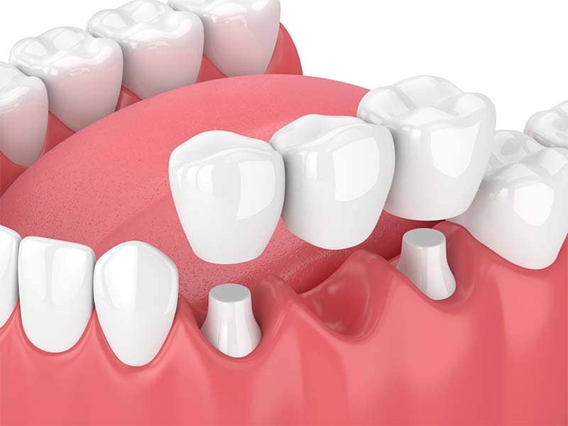 illustration depicting a fixed dental bridge.