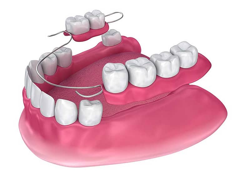 3D illustration of a partial denture.