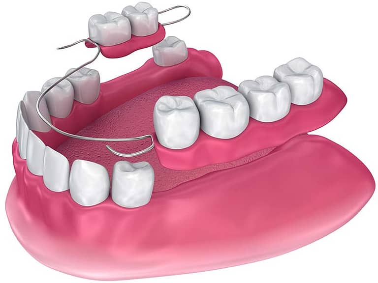 illustration demonstrating a partial denture.