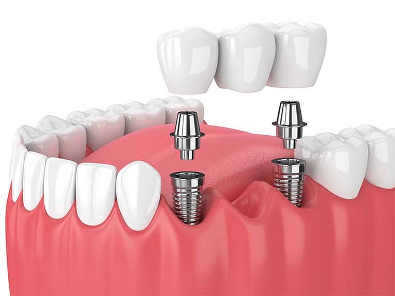 Illustration of a Implant Fixed Dental Bridge