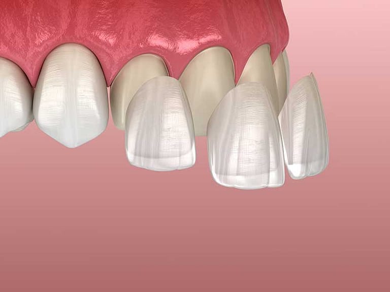 Depiction of dental veneers.