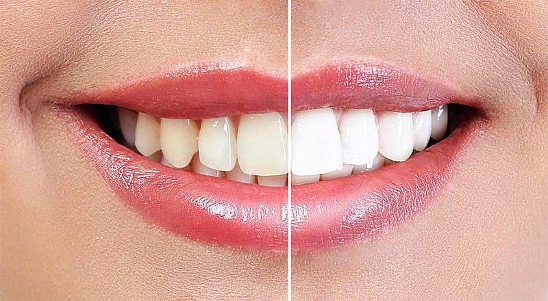 Before and after of teeth whitening.