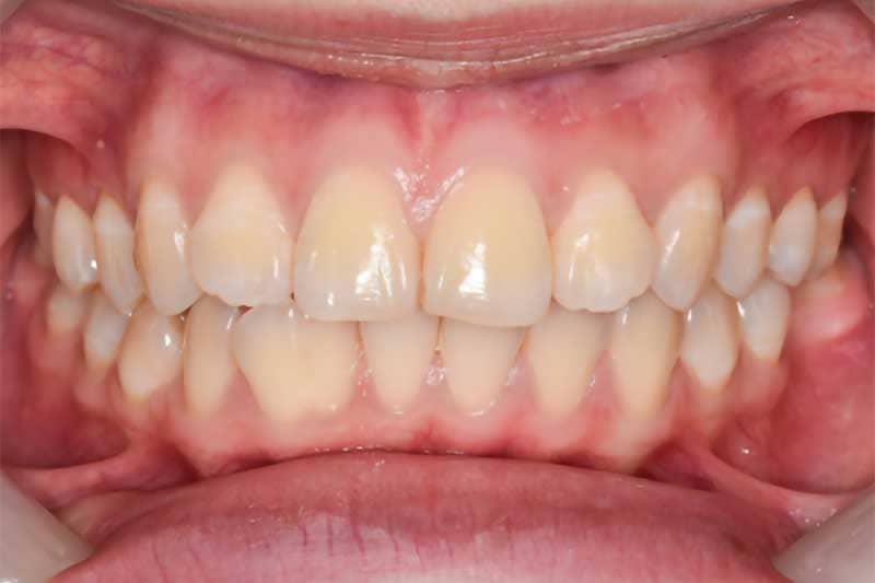 Healthy teeth and gums with no periodontal disease.