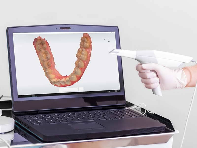 3D Scanner for digital dental impressions.