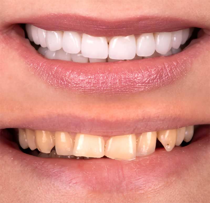 Teeth whitening before and after comparison.
